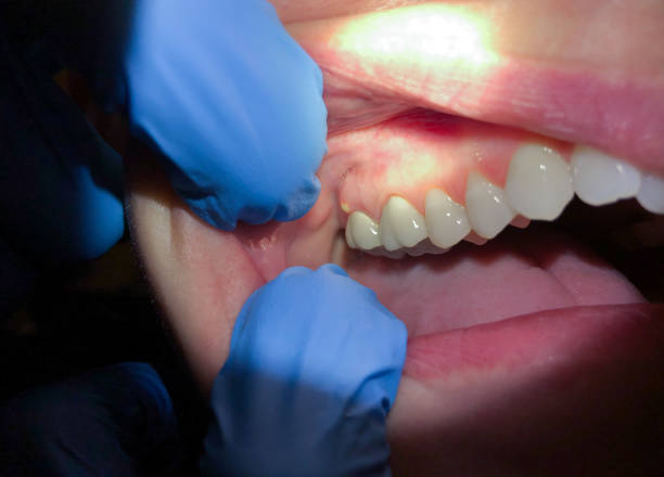 Best Emergency Tooth Extraction  in Athens, OH